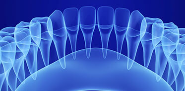 Dental Implants X-Ray